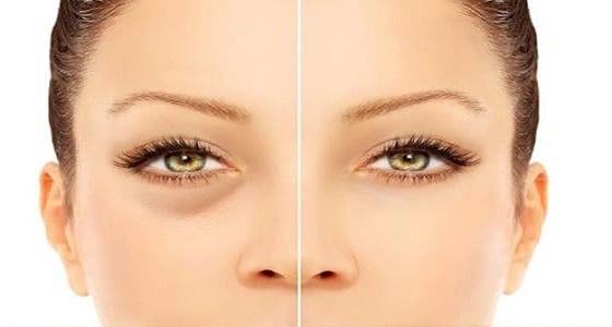 4 أسباب وراء انتفاخات أسفل العين