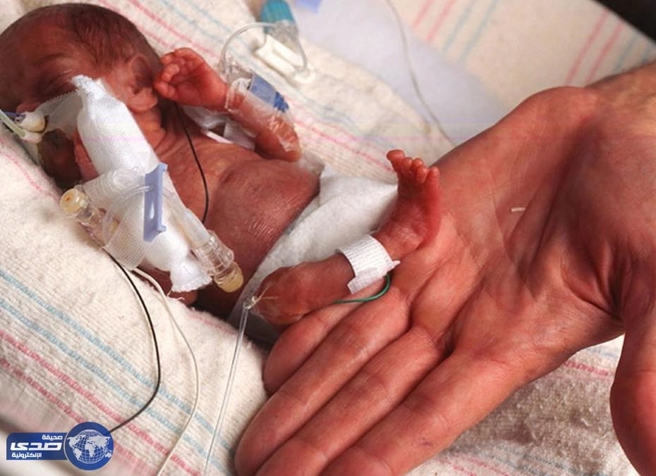 طفلة وزنها أقل من كيس السكر تنجح في البقاء حية