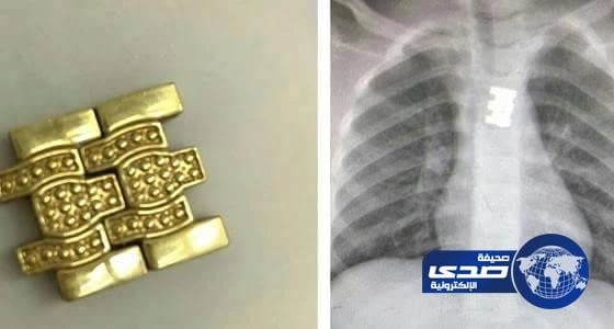بالصور..مستشفى بريدة ينجح في استخراج قطعة "نُحاس" من مَرِيء طفلة
