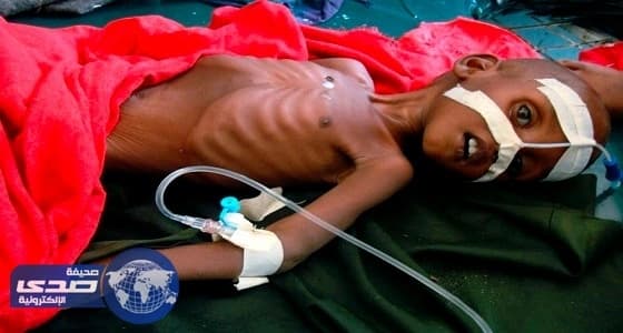 موجة جفاف وسوء تغذية تودي بحياة 5 أطفال فى باكستان
