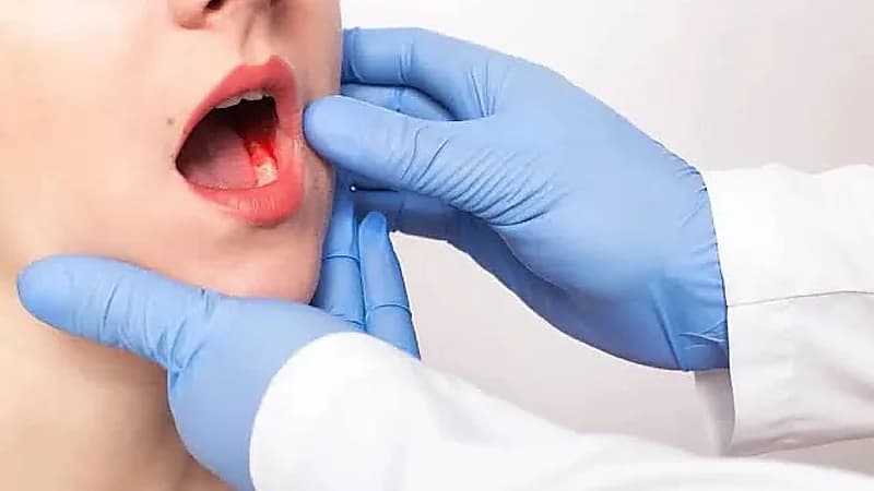 العلامات المبكرة لسرطان الفم