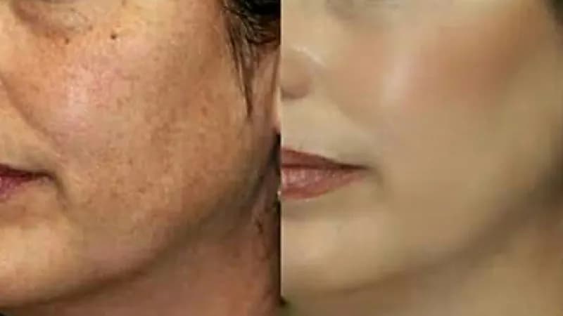 خطوات لتوحيد لون البشرة والتخلص من البقع