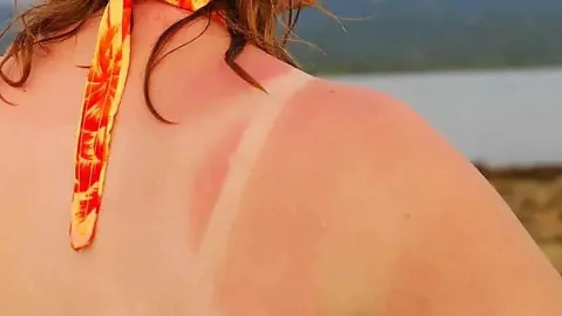 فرنسا تحذر من ترند خطوط الحروق على تيك توك