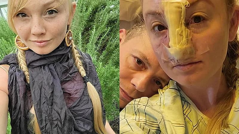 كلب بيتبول ينهش أنف صاحبته