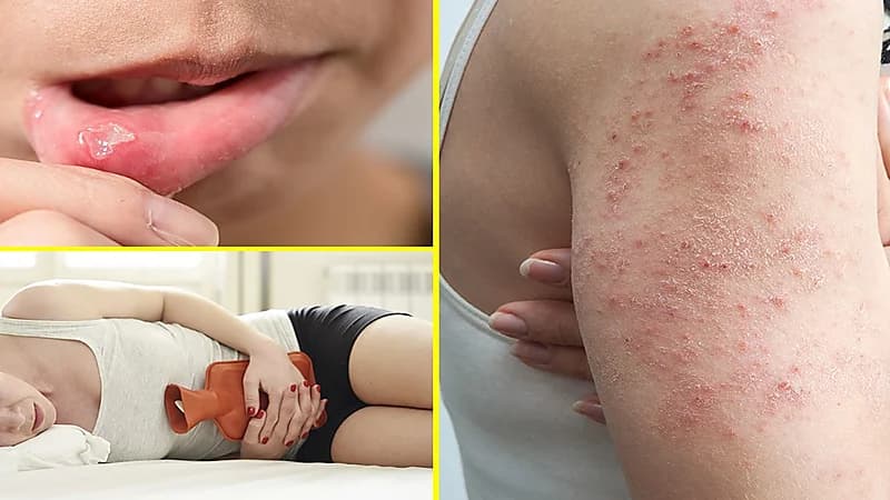 استشاري يوضح أعراض الإصابة بالسيلياك وكيفية التعامل مع المرض.. فيديو