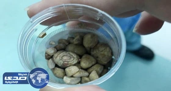 فريق طبي بمستشفى الملك فهد في جدة يستخرج 100 حصوة من مثانة سبعيني