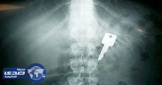 أغرب ما وجده الأطباء داخل أجساد المرضى بالمملكة