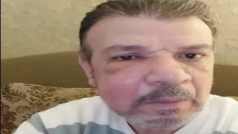 أحمد سلامة يظهر بوجه متورم ويثير قلق جمهوره