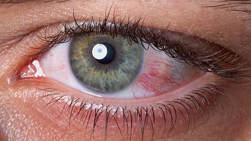أخصائي بصريات يوضح أسباب جفاف العيون وأعراضه المزعجة