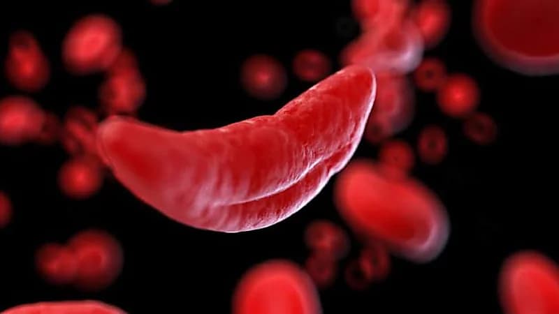 بقنة: فقر الدم المنجلي لا يصيب الدم فقط بل يطال كل عضو تقريبًا .. فيديو