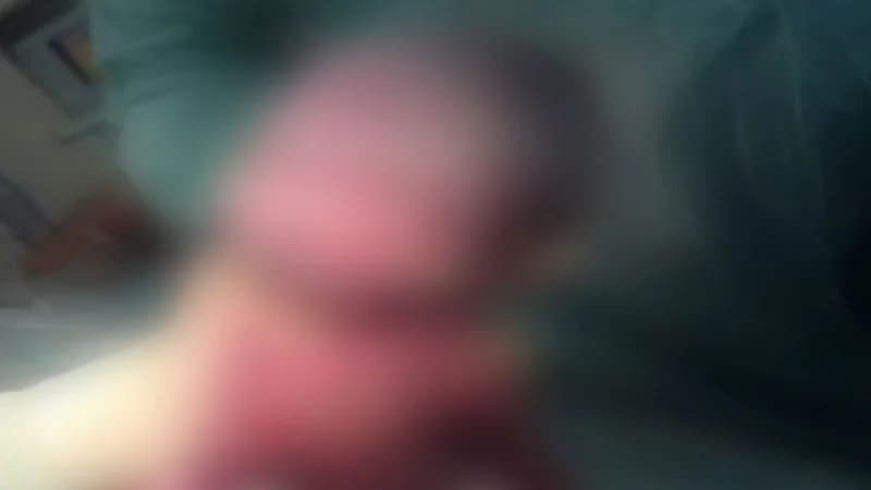 ولادة نادرة لطفل بملامح مزدوجة في أربيل تثير اهتمامًا طبيًا واسعًا