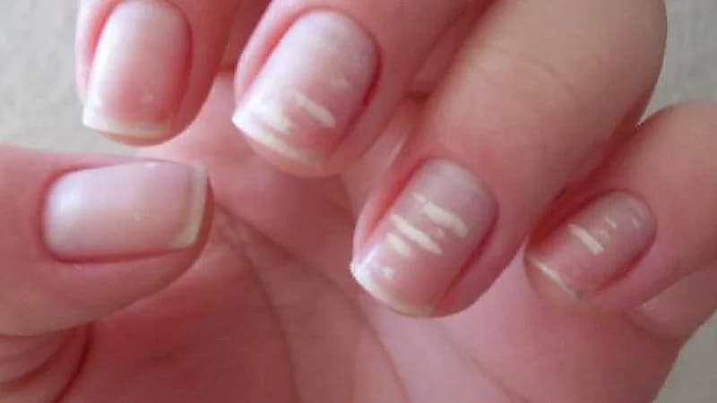 أسباب ظهور بقع بيضاء على الأظافر